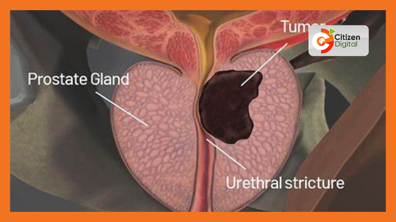 Prostate Cancer in Kenya